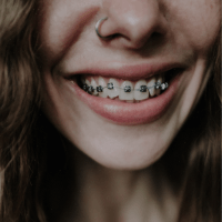 Logopedia ortodontyczna